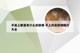 手面上都是有什么皮肤病 手上的皮肤病图片大全