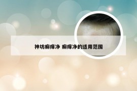神坊癣痒净 癣痒净的适用范围