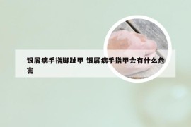 银屑病手指脚趾甲 银屑病手指甲会有什么危害