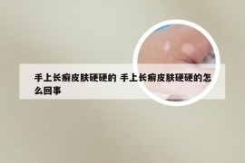 手上长癣皮肤硬硬的 手上长癣皮肤硬硬的怎么回事