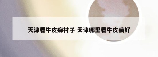 天津看牛皮癣村子 天津哪里看牛皮癣好