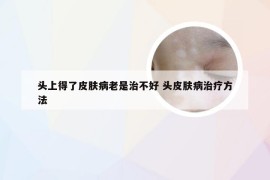 头上得了皮肤病老是治不好 头皮肤病治疗方法