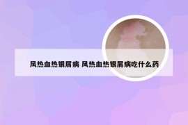 风热血热银屑病 风热血热银屑病吃什么药