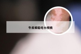 牛皮癣能吃小核桃