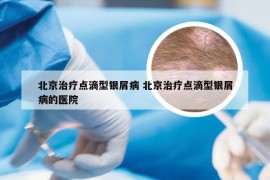 北京治疗点滴型银屑病 北京治疗点滴型银屑病的医院