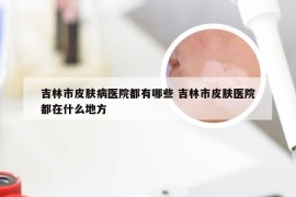 吉林市皮肤病医院都有哪些 吉林市皮肤医院都在什么地方