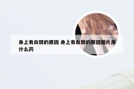 身上有白斑的原因 身上有白斑的原因图片用什么药