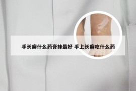 手长癣什么药膏抹最好 手上长癣吃什么药