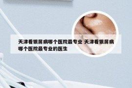 天津看银屑病哪个医院最专业 天津看银屑病哪个医院最专业的医生
