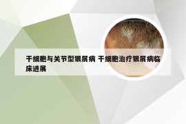 干细胞与关节型银屑病 干细胞治疗银屑病临床进展
