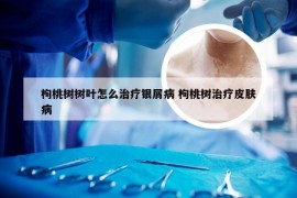 枸桃树树叶怎么治疗银屑病 枸桃树治疗皮肤病
