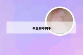 牛皮癣不同于