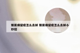 银屑病留疤怎么去掉 银屑病留疤怎么去掉小妙招