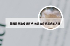 美国最新治疗银屑病 美国治疗银屑病的方法