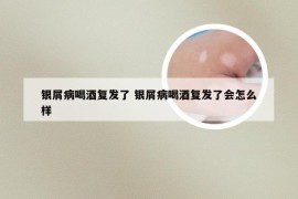 银屑病喝酒复发了 银屑病喝酒复发了会怎么样