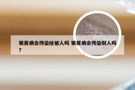 银屑病会传染给被人吗 银屑病会传染别人吗?