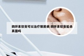 四环素软膏可以治疗银屑病 四环素软膏能杀真菌吗