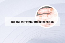 银屑病可以不管他吗 银屑病不能根治吗?