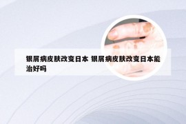 银屑病皮肤改变日本 银屑病皮肤改变日本能治好吗