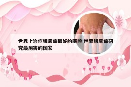 世界上治疗银屑病最好的医院 世界银屑病研究最厉害的国家