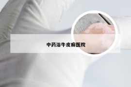 中药浴牛皮癣医院
