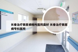 长春治疗银屑病哪所医院最好 长春治疗银屑病专科医院
