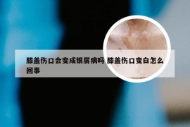膝盖伤口会变成银屑病吗 膝盖伤口变白怎么回事