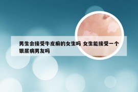 男生会接受牛皮癣的女生吗 女生能接受一个银屑病男友吗