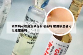 银屑病可以用玉米淀粉泡澡吗 银屑病患者可以吃玉米吗