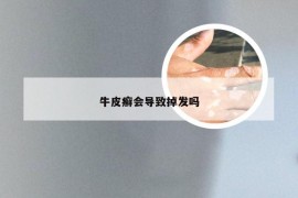 牛皮癣会导致掉发吗