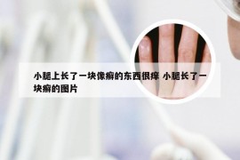 小腿上长了一块像癣的东西很痒 小腿长了一块癣的图片