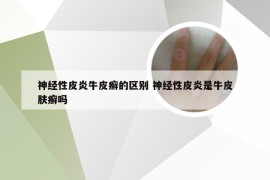 神经性皮炎牛皮癣的区别 神经性皮炎是牛皮肤癣吗