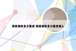 银屑病有多少重症 银屑病有多少重症病人