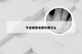 牛皮癣患皮肤外敷什么