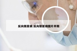 反向银屑病 反向银屑病图片早期