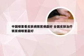 中国哪里看皮肤病银屑病最好 全国皮肤治疗银屑病哪里最好