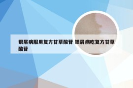 银屑病服用复方甘草酸苷 银屑病吃复方甘草酸苷