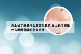 身上长了癣是什么原因引起的 身上长了癣是什么原因引起的怎么治疗