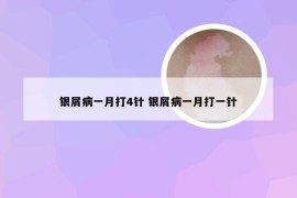 银屑病一月打4针 银屑病一月打一针