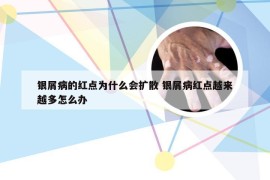 银屑病的红点为什么会扩散 银屑病红点越来越多怎么办