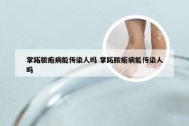 掌跖脓疱病能传染人吗 掌跖脓疱病能传染人吗