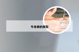 牛皮癣的类型