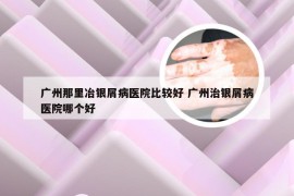 广州那里冶银屑病医院比较好 广州治银屑病医院哪个好