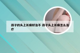 孩子的头上长癣好治不 孩子头上长癣怎么治疗