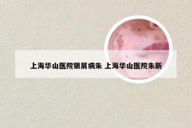 上海华山医院银屑病朱 上海华山医院朱新