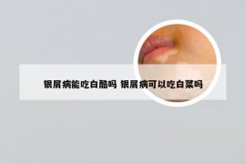 银屑病能吃白酷吗 银屑病可以吃白菜吗