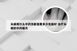 头癣用什么中药洗都是要多少克最好 治疗头癣的中药偏方