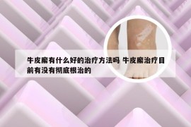 牛皮廨有什么好的治疗方法吗 牛皮廨治疗目前有没有彻底根治的