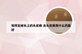 如何去掉头上的头皮癣 去头皮癣用什么药最好