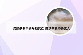 皮肤病会不会导致死亡 皮肤病会不会死人